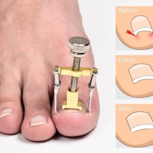 Professional Ingrown Nail Treatment (Per Nail)