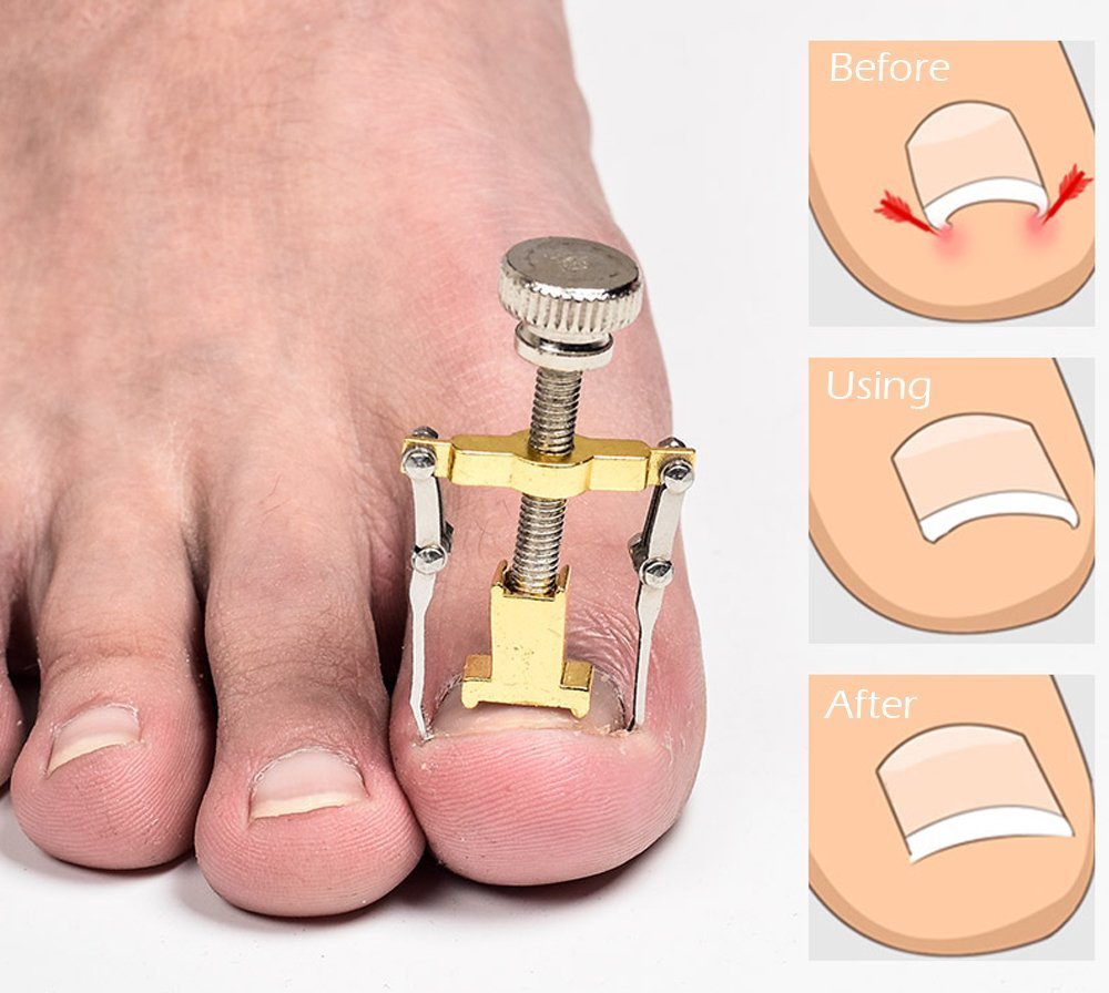 Professional Ingrown Nail Treatment (Per Nail)