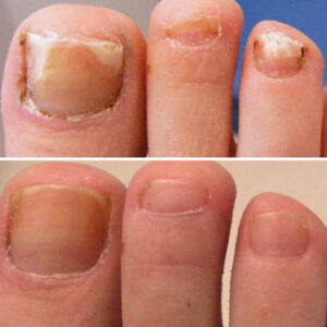 Nail Fungus Care Treatment (Per Nail)