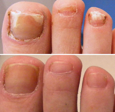 Nail Fungus Care Treatment (Per Nail)